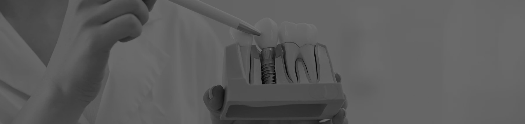 FULL MOUTH DENTAL IMPLANTS